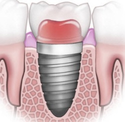chirurgien dentiste bordeaux schéma implant dentaire