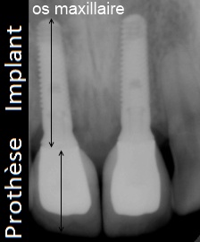 chirurgien dentiste bordeaux radiographie implants et prothese