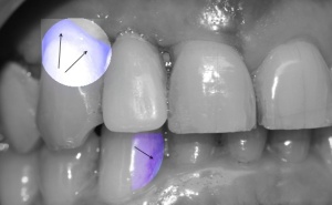 chirurgien dentiste bordeaux plaque dentaire tartre