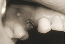chirurgien dentiste bordeaux fracture racine dentaire