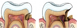 chirurgien dentiste bordeaux progresion d'une carie