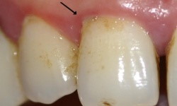 chirurgien dentiste bordeaux gengivite avant parodontie médicale