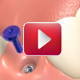   VIDEO |  Pose d un implant dentaire  